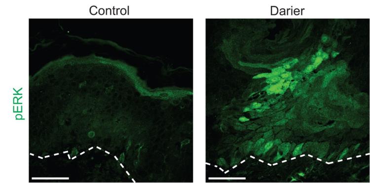 Staining of skin biopsies from control patients compared to those with Darier disease revealed increased activation of MEK’s substrate, ERK.